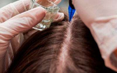 Tricoscopia: Como Tratar Queda de Cabelo